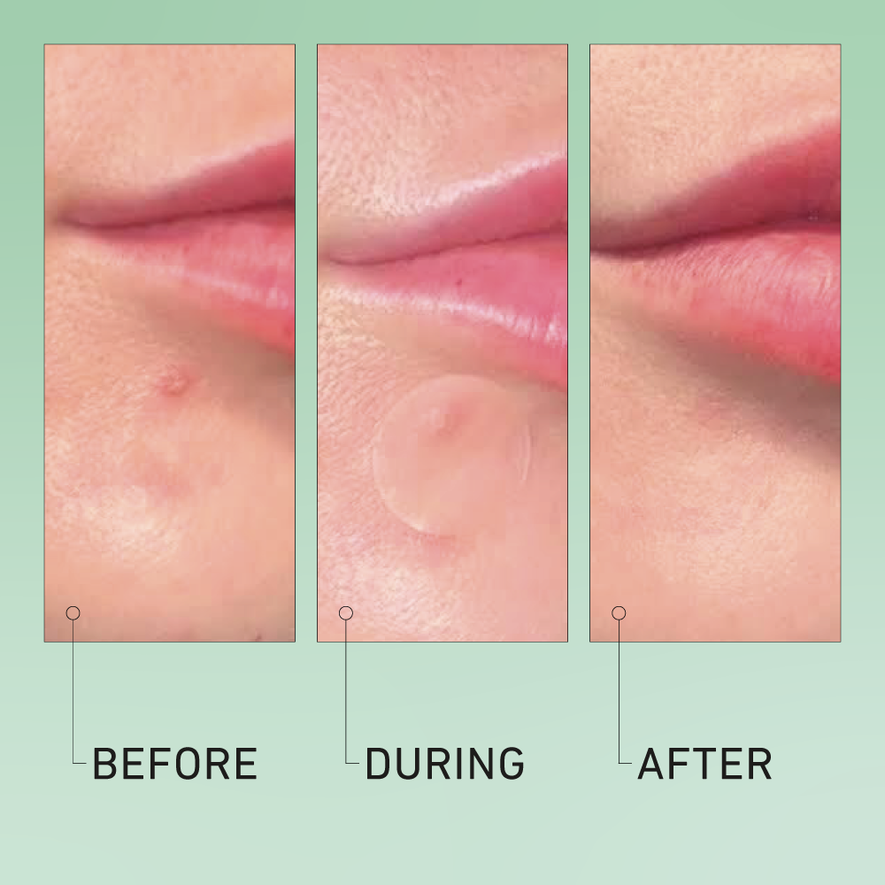 Luna hydrocolloid acne pimple patch