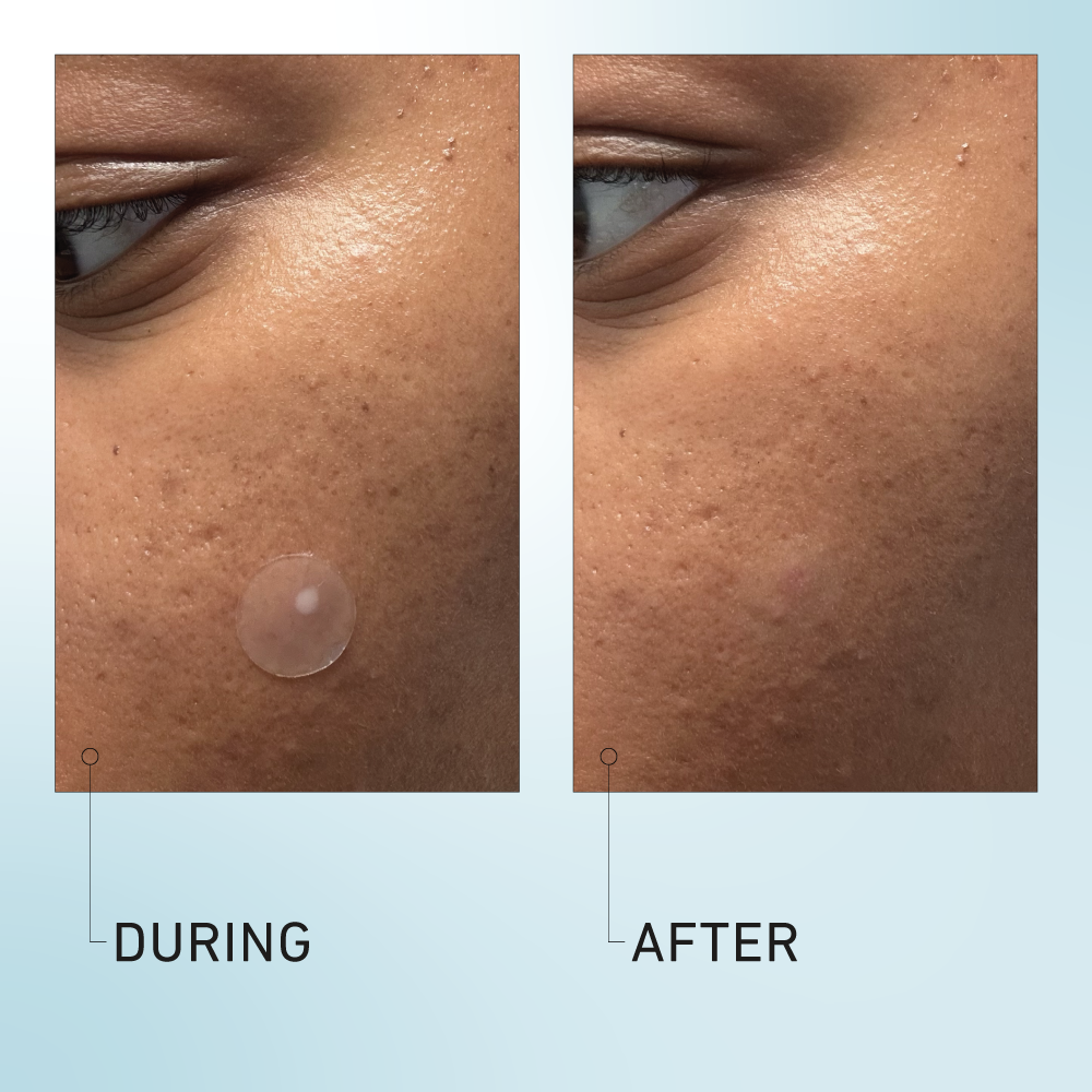 Luna hydrocolloid acne pimple patch
